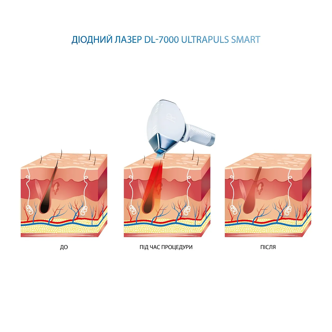 crm для діодного лазера DL-7000 UltraPuls Smart